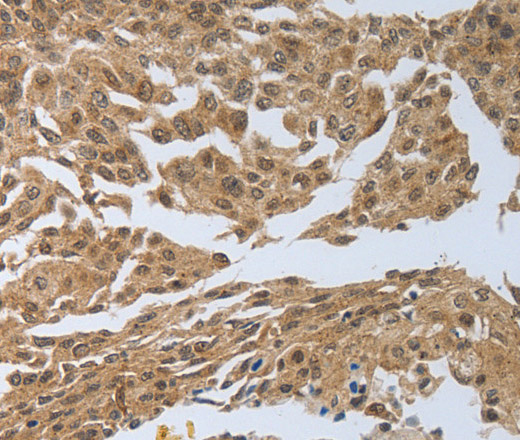 Immunohistochemistry of paraffin-embedded Human cervical cancer using PSMD6 Polyclonal Antibody at dilution of 1:40