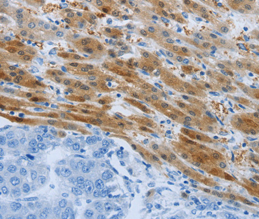 Immunohistochemistry of paraffin-embedded Human liver cancer tissue using PSMD11 Polyclonal Antibody at dilution 1:50