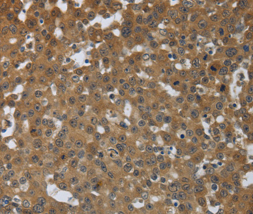 Immunohistochemistry of paraffin-embedded Human breast cancer tissue using PTPRM Polyclonal Antibody at dilution 1:40