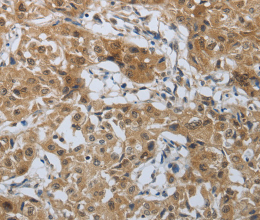 Immunohistochemistry of paraffin-embedded Human lung cancer tissue using PTPRM Polyclonal Antibody at dilution 1:40