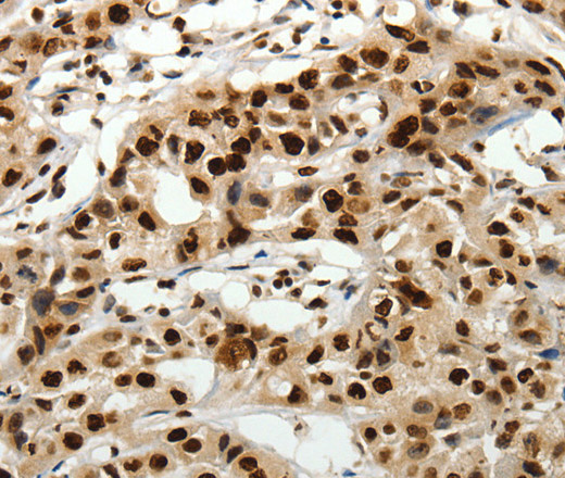 Immunohistochemistry of paraffin-embedded Human lung cancer tissue using SCN1A Polyclonal Antibody at dilution 1:40