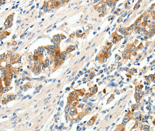 Immunohistochemistry of paraffin-embedded Human gastric cancer tissue using SCN9A Polyclonal Antibody at dilution 1:40