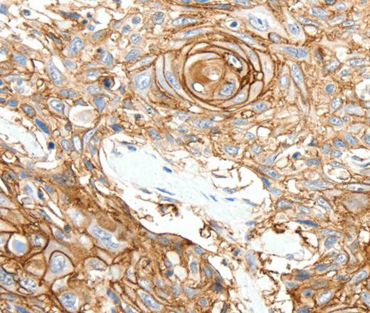 Immunohistochemistry of paraffin-embedded Human esophagus cancer tissue using SCN10A Polyclonal Antibody at dilution 1:25