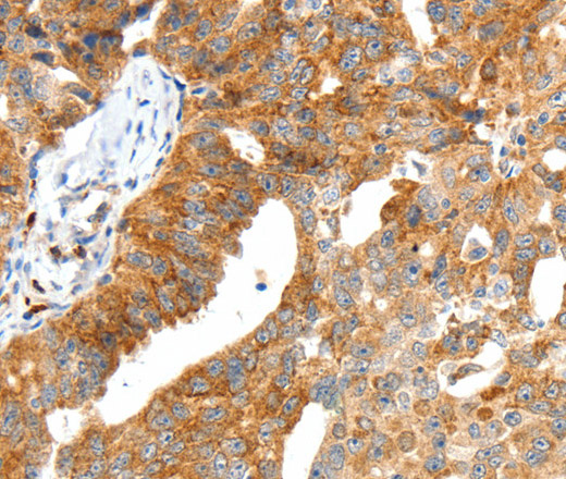 Immunohistochemistry of paraffin-embedded Human ovarian cancer tissue using SCT Polyclonal Antibody at dilution 1:40