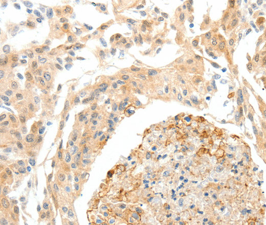 Immunohistochemistry of paraffin-embedded Human cervical cancer tissue using SEMA3D Polyclonal Antibody at dilution 1:50