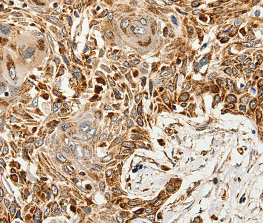 Immunohistochemistry of paraffin-embedded Human esophagus cancer tissue using SLC9A7 Polyclonal Antibody at dilution 1:60