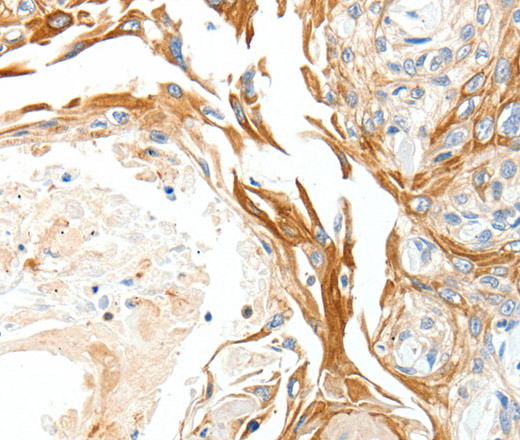 Immunohistochemistry of paraffin-embedded Human esophagus cancer using PLAT Polyclonal Antibody at dilution of 1:50