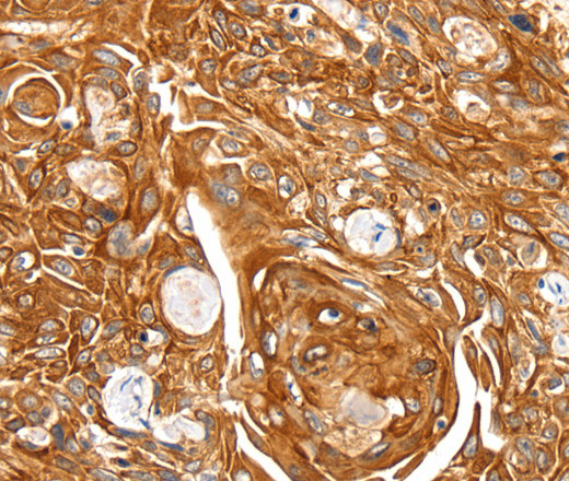 Immunohistochemistry of paraffin-embedded Human esophagus cancer using SFTPA1 Polyclonal Antibody at dilution of 1:30