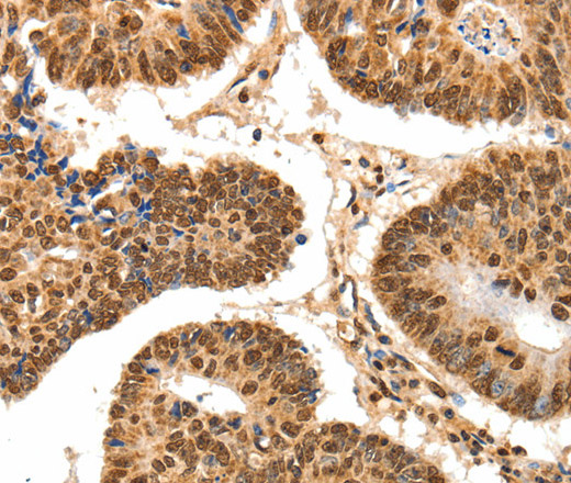 Immunohistochemistry of paraffin-embedded Human colon cancer tissue using SPATA20 Polyclonal Antibody at dilution 1:70