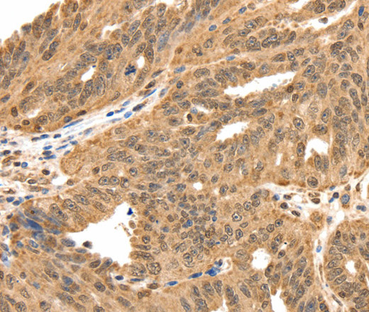 Immunohistochemistry of paraffin-embedded Human ovarian cancer tissue using SPATA20 Polyclonal Antibody at dilution 1:70