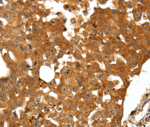 Immunohistochemistry of paraffin-embedded Human breast cancer tissue using SSTR1 Polyclonal Antibody at dilution 1:50