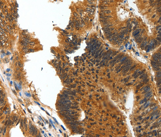 Immunohistochemistry of paraffin-embedded Human colon cancer tissue using BIRC6 Polyclonal Antibody at dilution 1:30