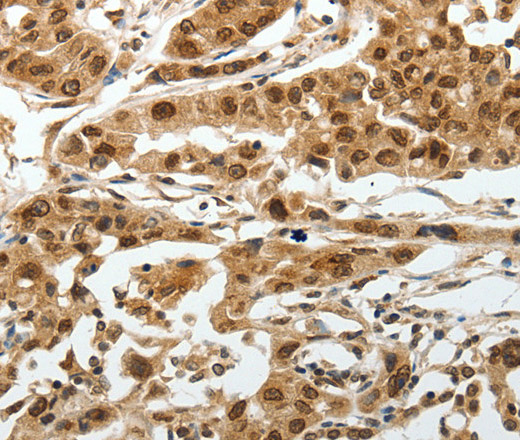 Immunohistochemistry of paraffin-embedded Human lung cancer tissue using SUMO1 Polyclonal Antibody at dilution 1:30