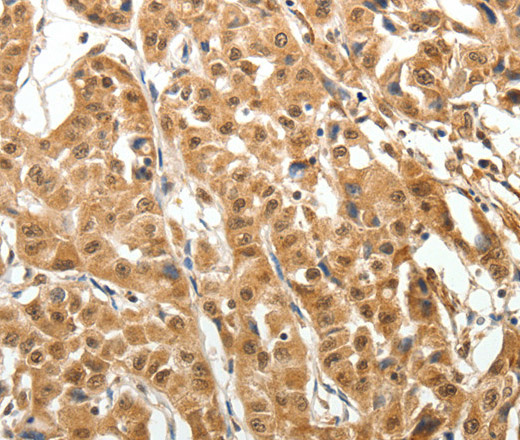 Immunohistochemistry of paraffin-embedded Human lung cancer tissue using MAP1A Polyclonal Antibody at dilution 1:40