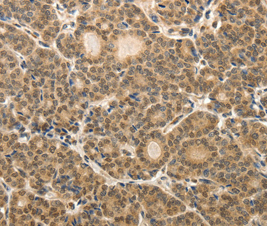 Immunohistochemistry of paraffin-embedded Human thyroid cancer tissue using MAP1A Polyclonal Antibody at dilution 1:40