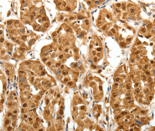 Immunohistochemistry of paraffin-embedded Human lung cancer tissue using TNN Polyclonal Antibody at dilution 1:40