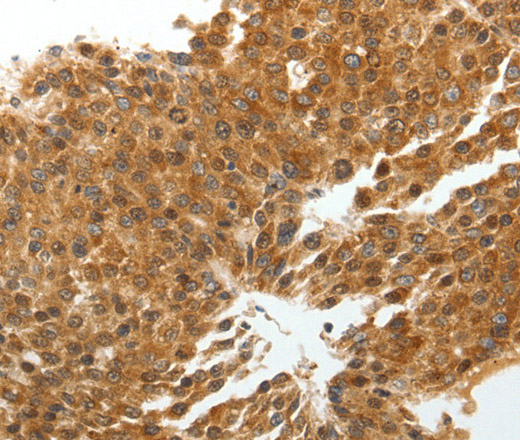 Immunohistochemistry of paraffin-embedded Human liver cancer tissue using TNXB Polyclonal Antibody at dilution 1:40