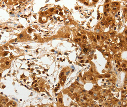 Immunohistochemistry of paraffin-embedded Human ovarian cancer tissue using TENM3 Polyclonal Antibody at dilution 1:50