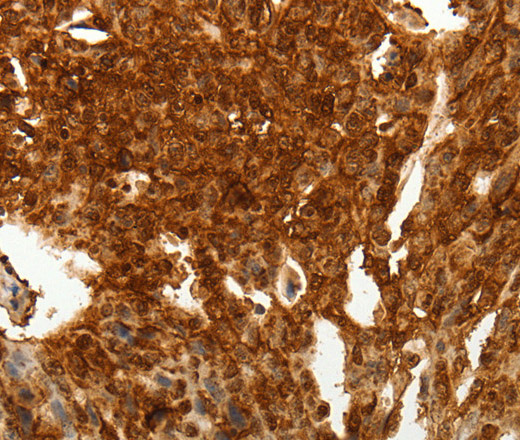 Immunohistochemistry of paraffin-embedded Human lung cancer tissue using TENM3 Polyclonal Antibody at dilution 1:50