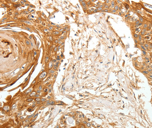 Immunohistochemistry of paraffin-embedded Human esophagus cancer tissue using TERT Polyclonal Antibody at dilution 1:40