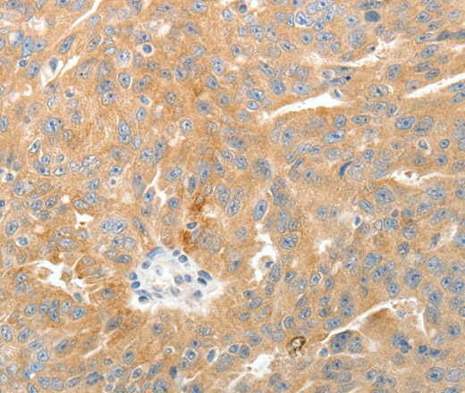 Immunohistochemistry of paraffin-embedded Human ovarian cancer tissue using TEP1 Polyclonal Antibody at dilution 1:50