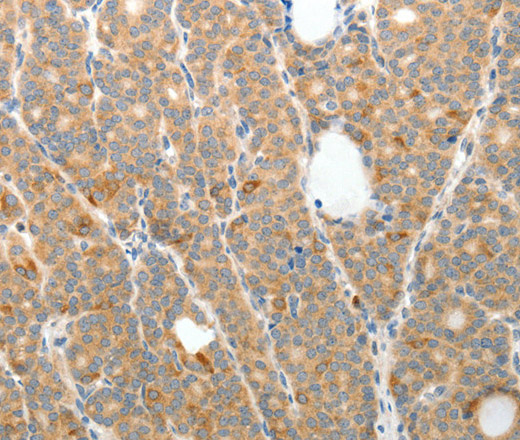 Immunohistochemistry of paraffin-embedded Human thyroid cancer tissue using TEP1 Polyclonal Antibody at dilution 1:50