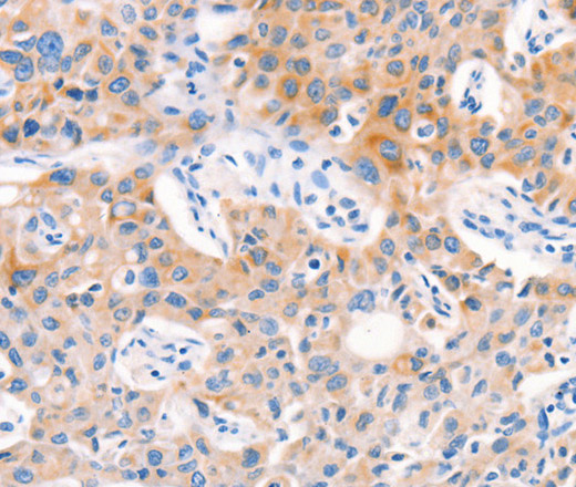 Immunohistochemistry of paraffin-embedded Human lung cancer tissue using Factor XIIIa Polyclonal Antibody at dilution 1:80