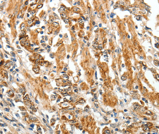 Immunohistochemistry of paraffin-embedded Human gastric cancer tissue using TGF β Receptor I Polyclonal Antibody at dilution 1:60