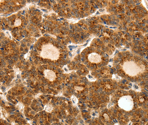 Immunohistochemistry of paraffin-embedded Human thyroid cancer tissue using TEK Polyclonal Antibody at dilution 1:50