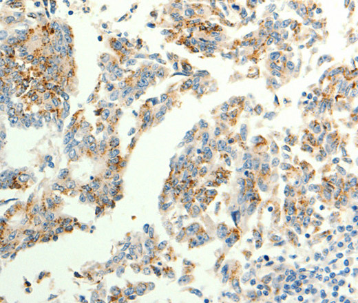 Immunohistochemistry of paraffin-embedded Human gastric cancer tissue using TRPC6 Polyclonal Antibody at dilution 1:40