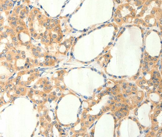 Immunohistochemistry of paraffin-embedded Human thyroid cancer using TRPM5 Polyclonal Antibody at dilution of 1:60