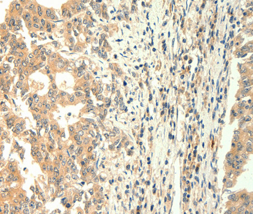 Immunohistochemistry of paraffin-embedded Human gastric cancer using TRPM5 Polyclonal Antibody at dilution of 1:60