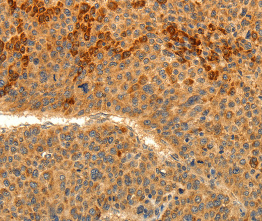 Immunohistochemistry of paraffin-embedded Human liver cancer tissue using TRPM7 Polyclonal Antibody at dilution 1:30