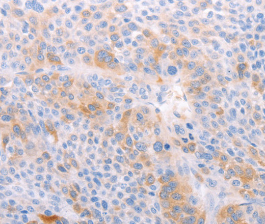 Immunohistochemistry of paraffin-embedded Human liver cancer using EDG6 Polyclonal Antibody at dilution of 1:40