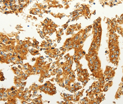 Immunohistochemistry of paraffin-embedded Human gastric cancer tissue using FZD6 Polyclonal Antibody at dilution 1:60