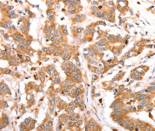 Immunohistochemistry of paraffin-embedded Human colon cancer tissue using CELSR2 Polyclonal Antibody at dilution 1:50