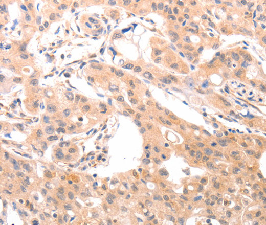 Immunohistochemistry of paraffin-embedded Human lung cancer tissue using ACO1 Polyclonal Antibody at dilution 1:50