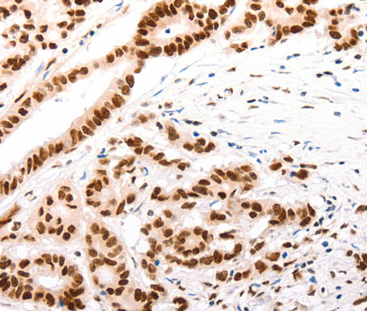 Immunohistochemistry of paraffin-embedded Human colon cancer tissue using CASP9 (active) Polyclonal Antibody at dilution 1:80