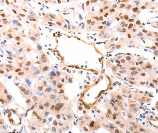 Immunohistochemistry of paraffin-embedded Human lung cancer tissue using CASP9 (active) Polyclonal Antibody  at dilution 1:80