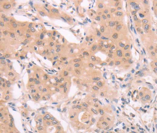 Immunohistochemistry of paraffin-embedded Human breast cancer using ADAM11 Polyclonal Antibody at dilution of 1:40