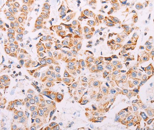 Immunohistochemistry of paraffin-embedded Human breast cancer tissue using ADAMTS16 Polyclonal Antibody at dilution 1:50