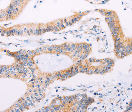 Immunohistochemistry of paraffin-embedded Human colon cancer tissue using ADAMTS16 Polyclonal Antibody at dilution 1:50