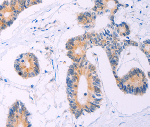 Immunohistochemistry of paraffin-embedded Human colon cancer tissue using ADCY5 Polyclonal Antibody at dilution 1:30