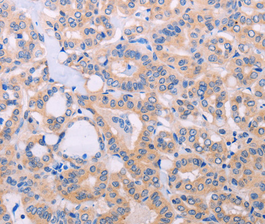 Immunohistochemistry of paraffin-embedded Human thyroid cancer tissue using ADCY5 Polyclonal Antibody at dilution 1:30