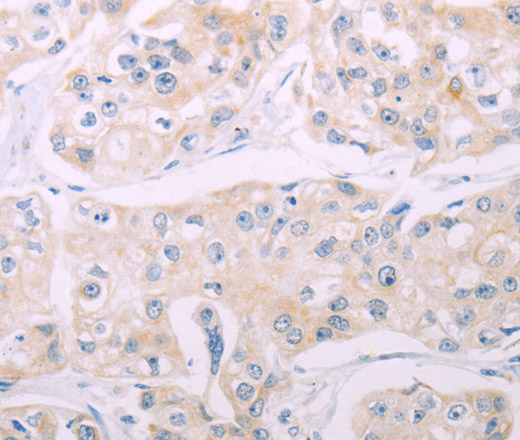 Immunohistochemistry of paraffin-embedded Human breast cancer tissue using ADCY7 Polyclonal Antibody at dilution 1:60