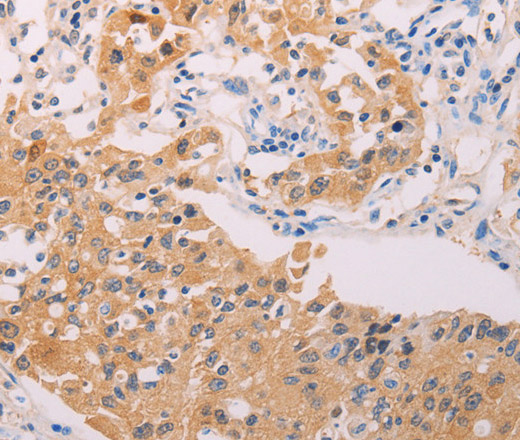 Immunohistochemistry of paraffin-embedded Human lung cancer tissue using ADHFE1 Polyclonal Antibody at dilution 1:30