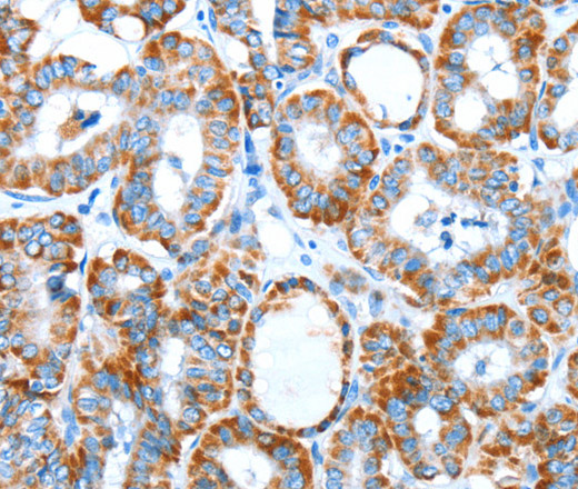 Immunohistochemistry of paraffin-embedded Human thyroid cancer tissue using ALDH5A1 Polyclonal Antibody at dilution 1:60