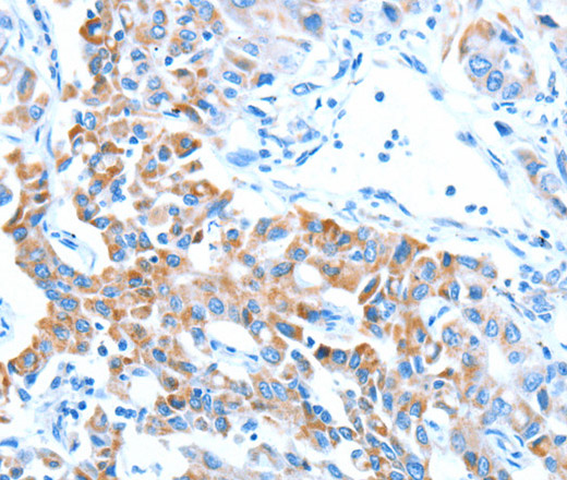 Immunohistochemistry of paraffin-embedded Human lung cancer tissue using ALDH5A1 Polyclonal Antibody at dilution 1:60