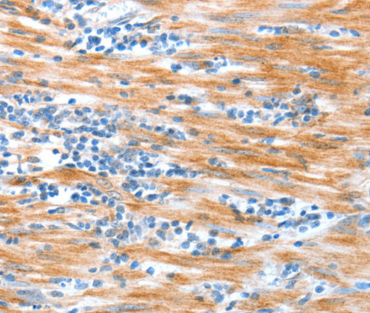 Immunohistochemistry of paraffin-embedded Human esophagus cancer using ALDOB Polyclonal Antibody at dilution of 1:40