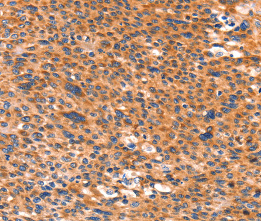 Immunohistochemistry of paraffin-embedded Human liver cancer using AMPD1 Polyclonal Antibody at dilution of 1:80